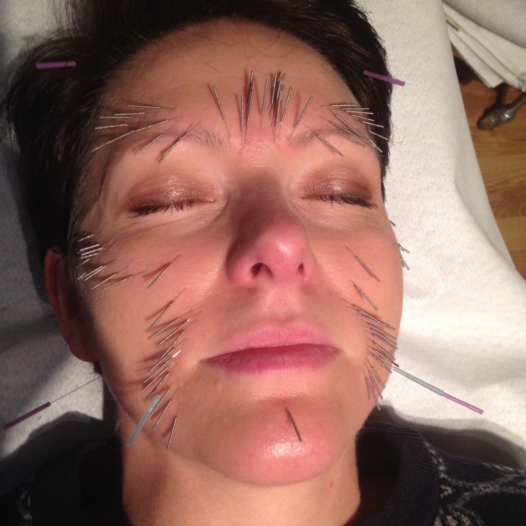 Hannah Sjöström kosmetisk akupunktur